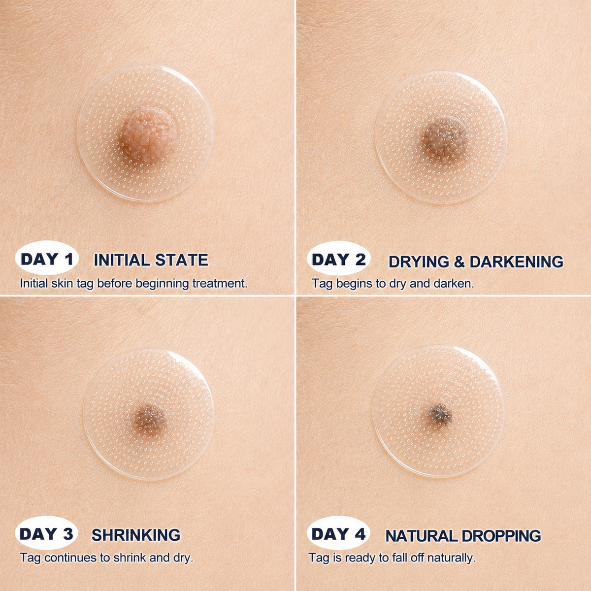 👍Official Brand Shop  | ☘️GFOUK®  Microneedle Skin Tag Removal Patch(𝐅𝐨𝐫 𝐒𝐤𝐢𝐧 𝐓𝐚𝐠𝐬, 𝐒𝐦𝐚𝐥𝐥 𝐒𝐤𝐢𝐧 𝐆𝐫𝐨𝐰𝐭𝐡𝐬, 𝐖𝐚𝐫𝐭𝐬, 𝐌𝐨𝐥𝐞𝐬, 𝐀𝐠𝐞 𝐒𝐩𝐨𝐭𝐬 & 𝐏𝐢𝐠𝐦𝐞𝐧𝐭𝐚𝐭𝐢𝐨𝐧 𝐂𝐨𝐧𝐜𝐞𝐫𝐧𝐬)