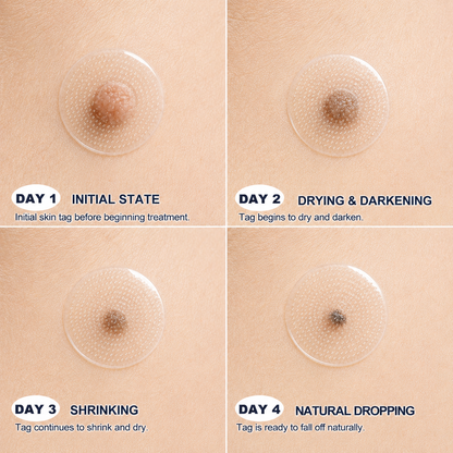 👍Official Brand Shop  | ☘️GFOUK®  Microneedle Skin Tag Removal Patch(𝐅𝐨𝐫 𝐒𝐤𝐢𝐧 𝐓𝐚𝐠𝐬, 𝐒𝐦𝐚𝐥𝐥 𝐒𝐤𝐢𝐧 𝐆𝐫𝐨𝐰𝐭𝐡𝐬, 𝐖𝐚𝐫𝐭𝐬, 𝐌𝐨𝐥𝐞𝐬, 𝐀𝐠𝐞 𝐒𝐩𝐨𝐭𝐬 & 𝐏𝐢𝐠𝐦𝐞𝐧𝐭𝐚𝐭𝐢𝐨𝐧 𝐂𝐨𝐧𝐜𝐞𝐫𝐧𝐬)