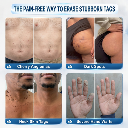 👍Official Brand Shop  | ☘️GFOUK®  Microneedle Skin Tag Removal Patch(𝐅𝐨𝐫 𝐒𝐤𝐢𝐧 𝐓𝐚𝐠𝐬, 𝐒𝐦𝐚𝐥𝐥 𝐒𝐤𝐢𝐧 𝐆𝐫𝐨𝐰𝐭𝐡𝐬, 𝐖𝐚𝐫𝐭𝐬, 𝐌𝐨𝐥𝐞𝐬, 𝐀𝐠𝐞 𝐒𝐩𝐨𝐭𝐬 & 𝐏𝐢𝐠𝐦𝐞𝐧𝐭𝐚𝐭𝐢𝐨𝐧 𝐂𝐨𝐧𝐜𝐞𝐫𝐧𝐬)