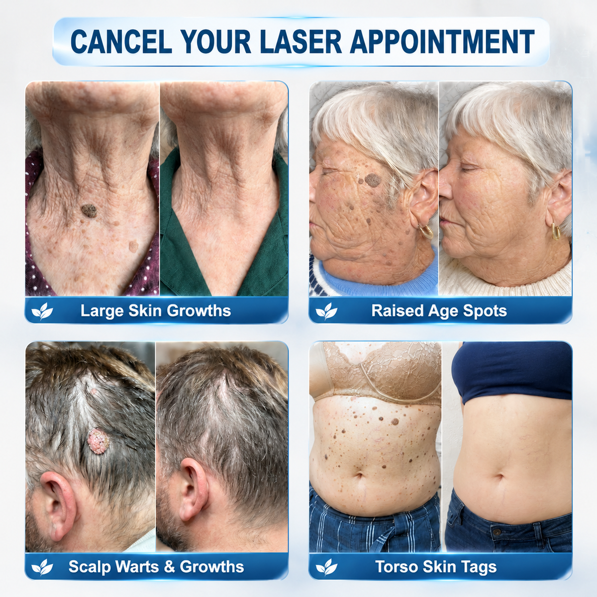 👍Official Brand Shop  | ☘️GFOUK®  Microneedle Skin Tag Removal Patch(𝐅𝐨𝐫 𝐒𝐤𝐢𝐧 𝐓𝐚𝐠𝐬, 𝐒𝐦𝐚𝐥𝐥 𝐒𝐤𝐢𝐧 𝐆𝐫𝐨𝐰𝐭𝐡𝐬, 𝐖𝐚𝐫𝐭𝐬, 𝐌𝐨𝐥𝐞𝐬, 𝐀𝐠𝐞 𝐒𝐩𝐨𝐭𝐬 & 𝐏𝐢𝐠𝐦𝐞𝐧𝐭𝐚𝐭𝐢𝐨𝐧 𝐂𝐨𝐧𝐜𝐞𝐫𝐧𝐬)
