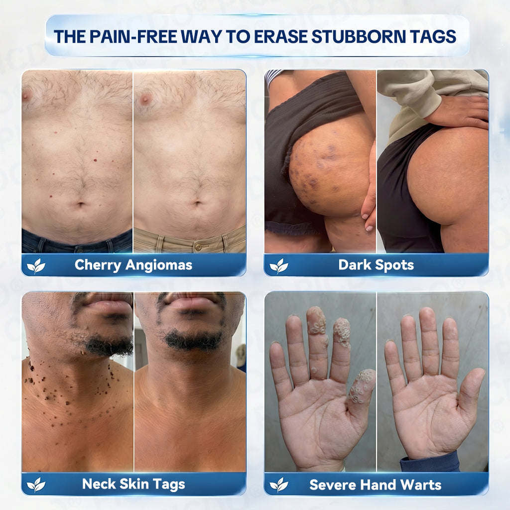 ✨Official Brand Shop |  GFOUK® 7-𝐃𝐚𝐲 𝐒𝐤𝐢𝐧 𝐓𝐚𝐠 & 𝐒𝐩𝐨𝐭 𝐄𝐫𝐚𝐬𝐞𝐫 𝐂𝐫𝐞𝐚𝐦 (Zero Pain, Zero 𝐒𝐜𝐚𝐫𝐬 Formula)