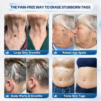 ✨Official Brand Shop |  GFOUK® 7-𝐃𝐚𝐲 𝐒𝐤𝐢𝐧 𝐓𝐚𝐠 & 𝐒𝐩𝐨𝐭 𝐄𝐫𝐚𝐬𝐞𝐫 𝐂𝐫𝐞𝐚𝐦 (Zero Pain, Zero 𝐒𝐜𝐚𝐫𝐬 Formula)