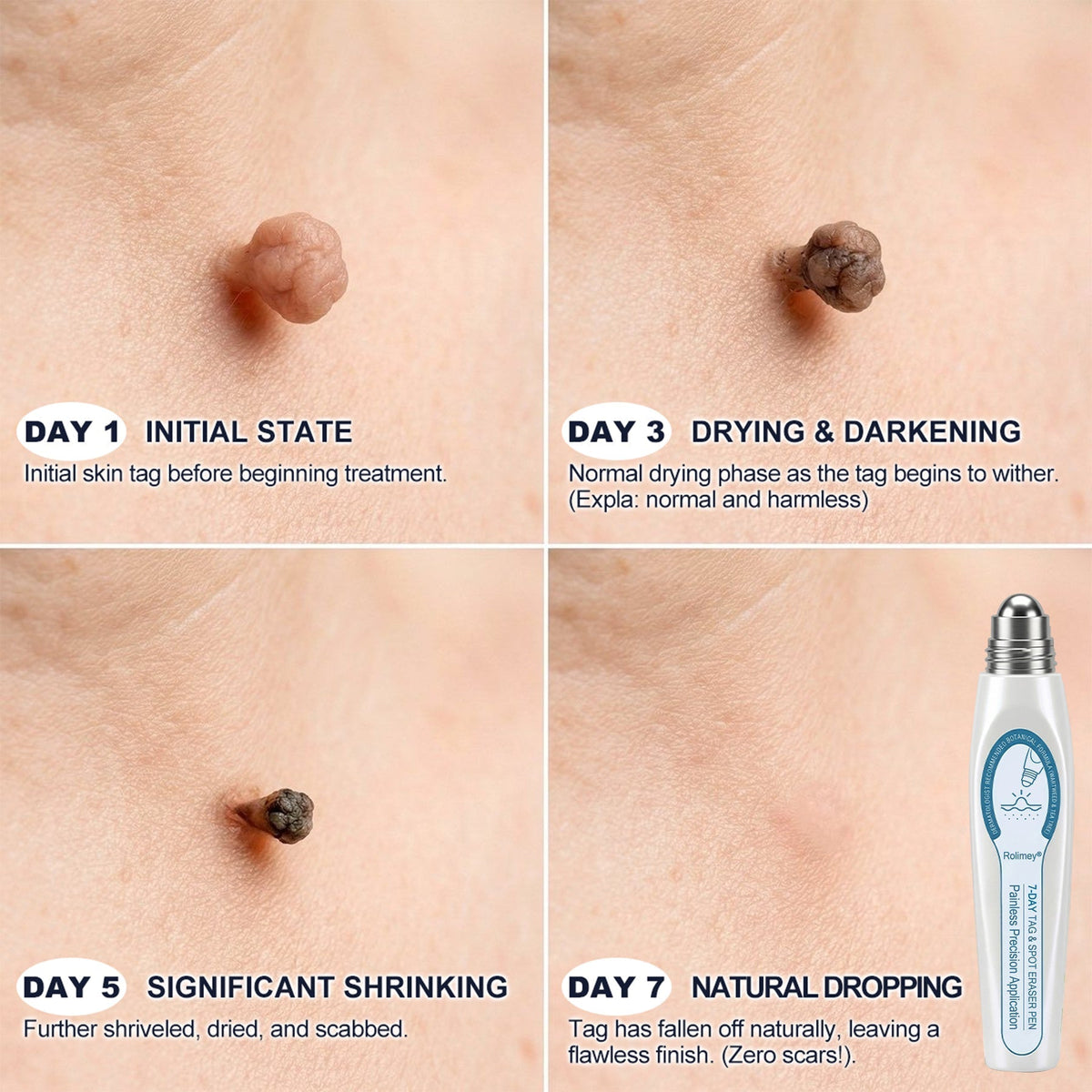 🌟Official Brand Shop | Rolimey® 7-Day Roll-On for Skin Spots and Skin Tags – Pain-Free & Scar-Free