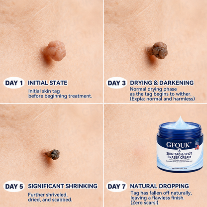 ✨Official Brand Shop |  GFOUK® 7-𝐃𝐚𝐲 𝐒𝐤𝐢𝐧 𝐓𝐚𝐠 & 𝐒𝐩𝐨𝐭 𝐄𝐫𝐚𝐬𝐞𝐫 𝐂𝐫𝐞𝐚𝐦 (Zero Pain, Zero 𝐒𝐜𝐚𝐫𝐬 Formula)