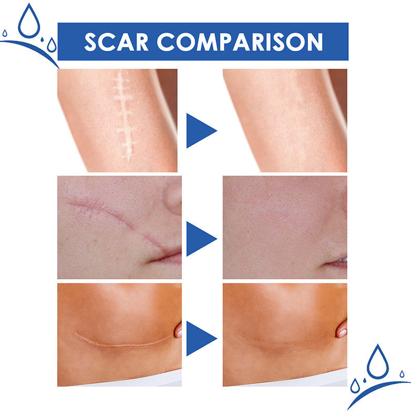 🧑‍⚕️🧑‍⚕️Final 3 Hours: 70%OFF🔥 GFOUK® Scar Repair Cream for Men and Women, fade scars and tighten skin in one step